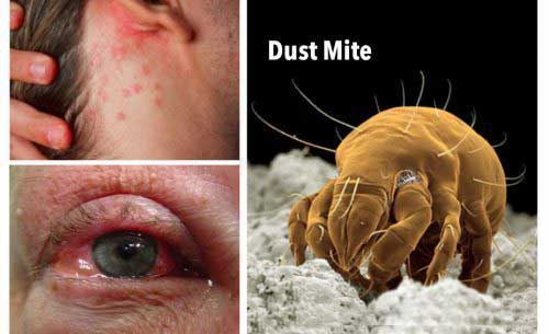 Dust Mites Allergies